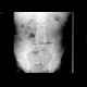 Ileus: X-ray - Plain radiograph